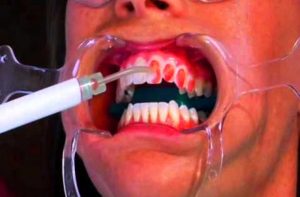 Фото профессионального отбеливание зубов Opalescence в Перми по низким ценам. Самое лучшее отбеливание зубов в стоматологической клинике София-Дента. Эффективно в домашних условиях. Чистка зубов, удаление зубного налета, лечение зубов 24 часа круглосуточно.