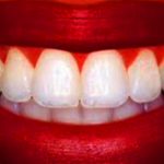 Фото: отбеливание зубов Opalescence в Перми по низким ценам. Самое лучшее отбеливание зубов в стоматологической клинике София-Дента. Эффективно в домашних условиях. Чистка зубов, удаление зубного налета, лечение зубов 24 часа круглосуточно.