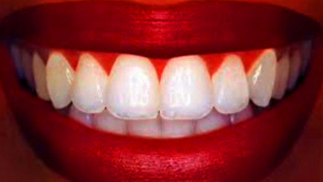 Отбеливание зубов Opalescence в Перми