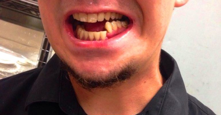 Почему при переломе челюсти болят зубы thumbnail