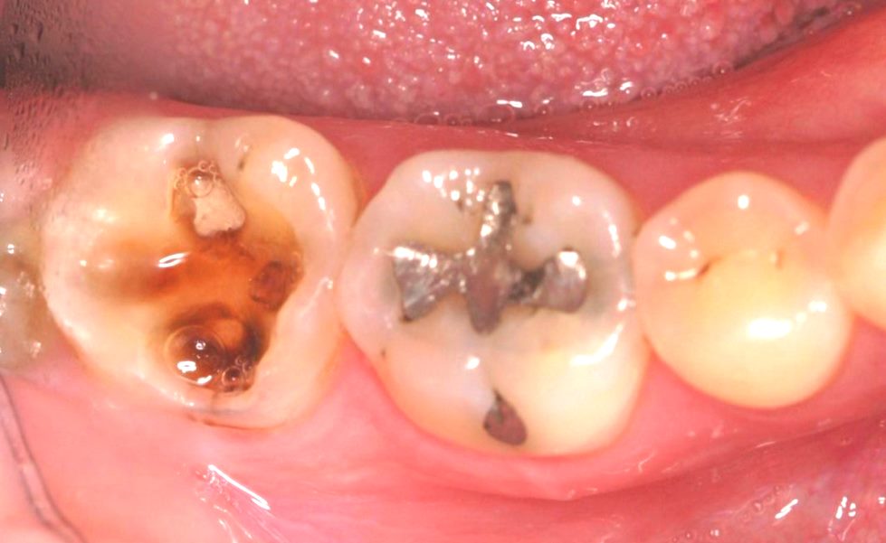 Пульпит: воспаление нерва и сильная зубная боль