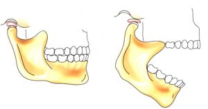 вывих нижней челюсти вправить в круглосуточной стоматологии София Дента в Перми рядом с травмпунктом