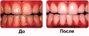 Фото до и после: отбеливание зубов Opalescence в Перми по низким ценам. Самое лучшее отбеливание зубов в стоматологической клинике София-Дента. Эффективно в домашних условиях. Чистка зубов, удаление зубного налета, лечение зубов 24 часа круглосуточно.