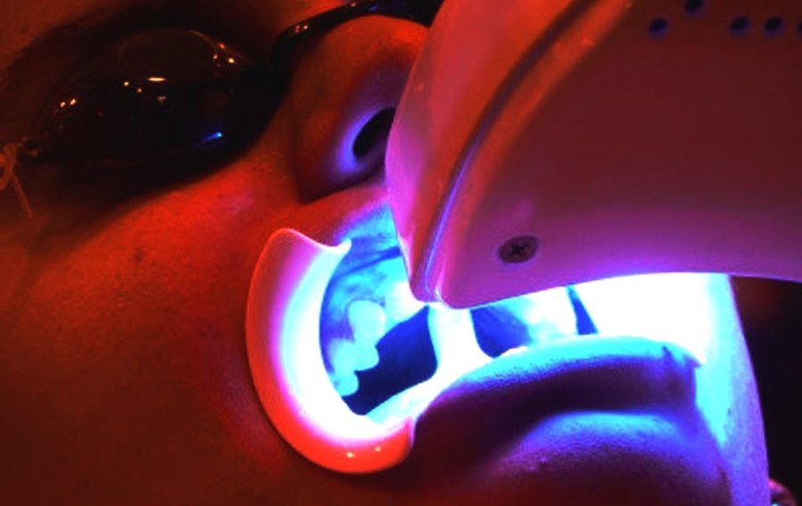 Лазерная чистка зубов
