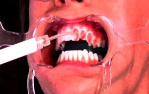 Фото: профессиональное отбеливание зубов Opalescence в Перми по низким ценам. Самое лучшее отбеливание зубов в стоматологической клинике София-Дента. Эффективно в домашних условиях. Чистка зубов, удаление зубного налета, лечение зубов 24 часа круглосуточно.