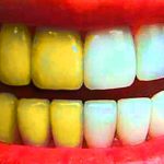 Чистка зубов и самые лучшие способы отбеливания зубов с хорошими отзывами. Профессиональное отбеливание зубов в Перми по низким ценам в стоматологии София-Дента в Мотовилихинском районе и центре города.