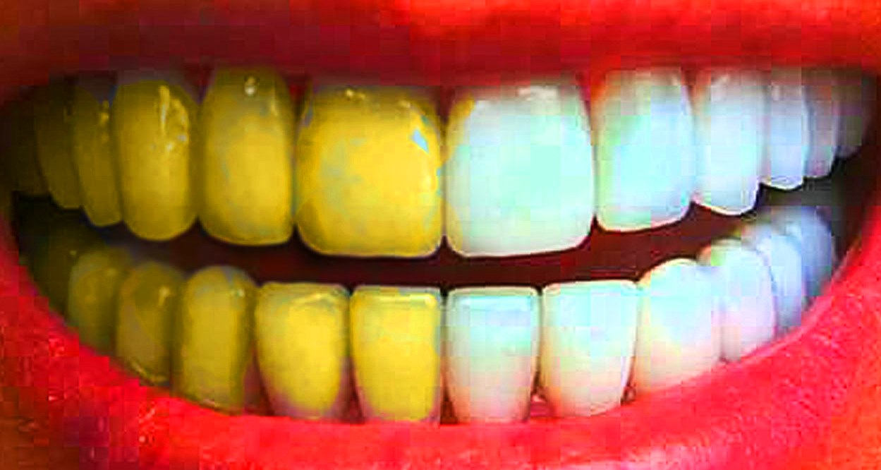 Виды отбеливания и профессиональной чистки зубов