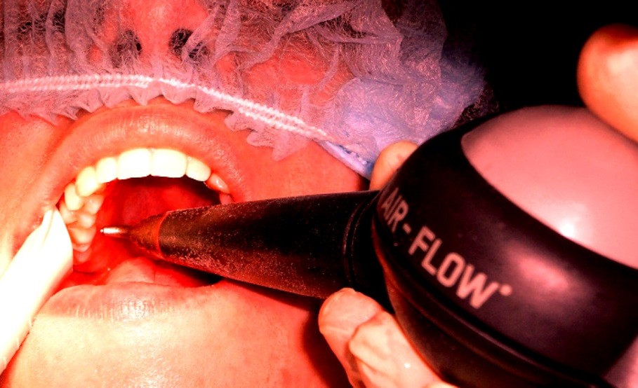Профессиональная чистка зубов Air-Flow