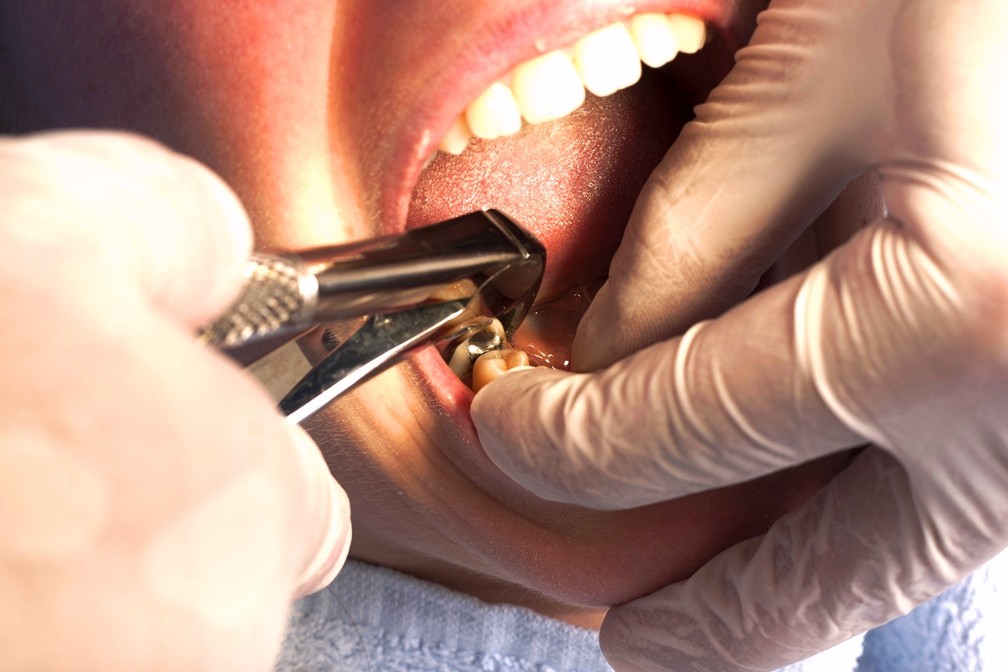 Удаление зубов в Перми