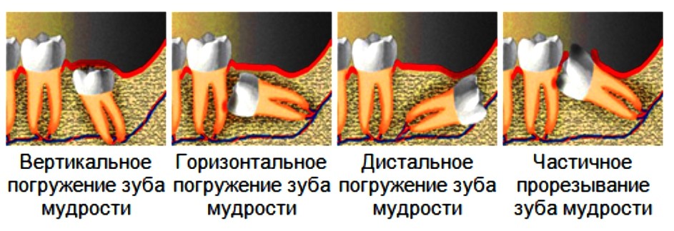 Зуб мудрости схема