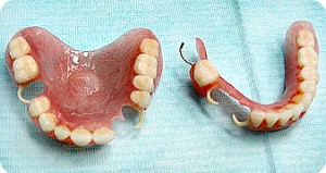 Частичный акриловый зубной протез на верхнюю и инжнюю челюсть в Перми: фото