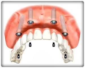 Полный съемный протез на имплантах с кнопочным креплением. Установка в Перми в стоматологии София-Дента