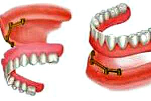 Съемные зубные протезы на имплантах в Перми: фото
