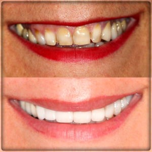 Установка коронок на зубы в Перми: фото до и после