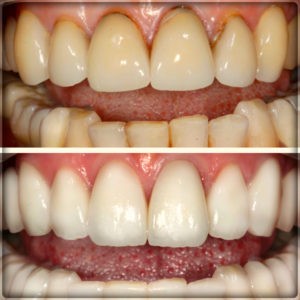 Установка металлокерамических коронок на зубы в Перми: фото до и после