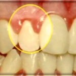 Киста зуба под коронкой. Лечение в Перми в стоматологии София-дента