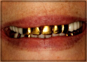 Установка металлической коронки из золота на зубы в Пер им