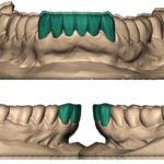 моделирование зубов перед протезированеим в перми Wax-up (Вакс ап)