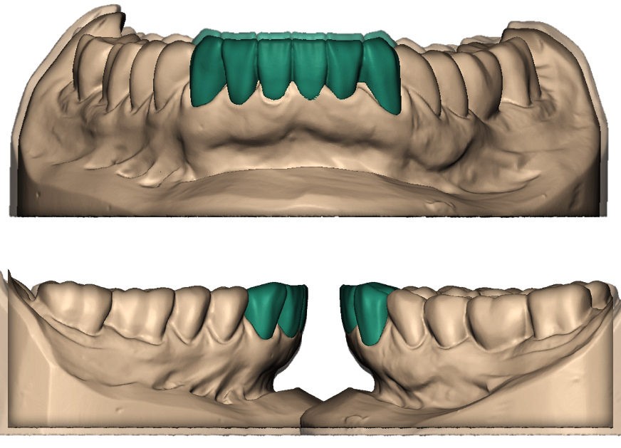 Wax-up моделирование зубов перед протезированием в Перми