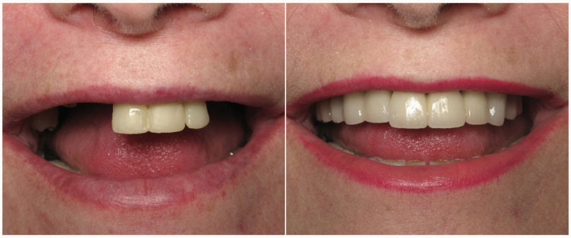 Вставить зубы в Перми мостовидным протезом в стоматологии София-Дента