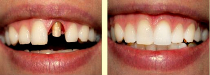 Керамическая коронка на зубы фото до и после. вставить зубы в Перми