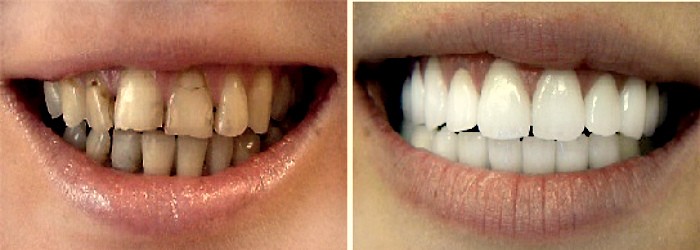 Фарфоровая коронка на зуб: фото до и после. вставить зубы в Перми недорого