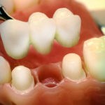 Вставить зубы в Перми: мостовидные протезы в стоматологии София-Дента