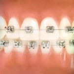 В стоматологии софия-Дента можно поставить металлические брекеты In Ovation R по низким ценам недорого в Перми