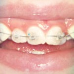 В стоматологии София дента пермь можно поставить керамические брекеты In-Ovation C по низкой цене недорого