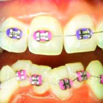 В стоматологии София-Дента проводят эффективное исправление прикуса. выравнивание неровных и кривых зубов недорого и качественно металлическими брекетами Мини-Мастер
