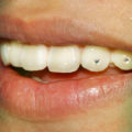 Украшение зуба скайсы и стразы на зубы в Перми по низким ценам в стоматологии София-дента.