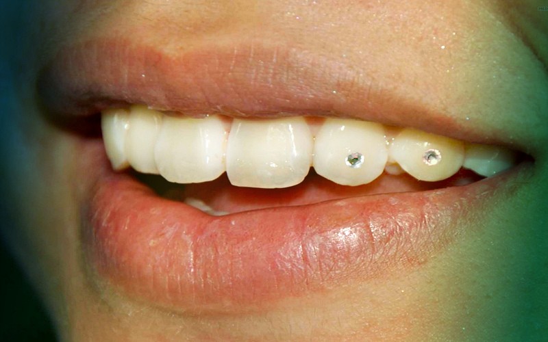 Украшение зубов скайсами (стразами) в Перми