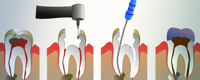 Этапы лечения пульпита в стоматологии София-дента
