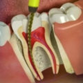 Лечение острого пульпита (зубной боли) круглосуточно без боли в стоматологии София-Дента.