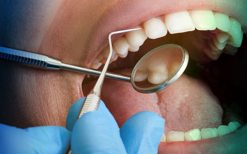 Профилактика кариеса у стоматолога