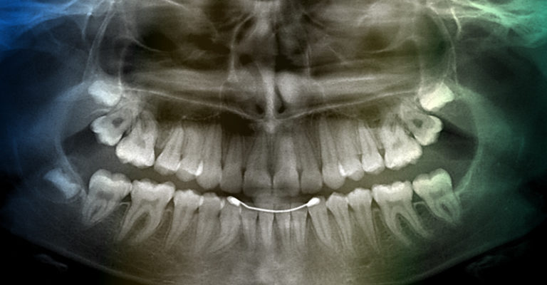 Как делается рентген зуба фото