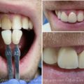 Керамика на зуб из оксида циркония в стоматологии софия-дента: фото до и после, цены,