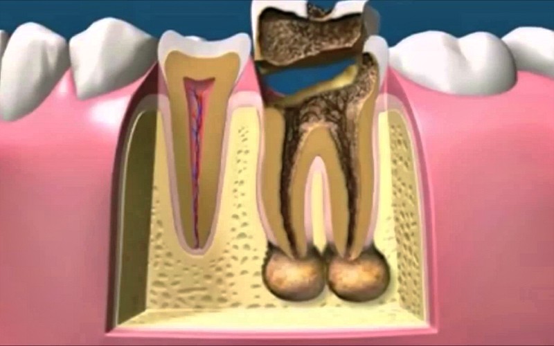 Лечение периодонтита (воспаление корня зуба) в Перми