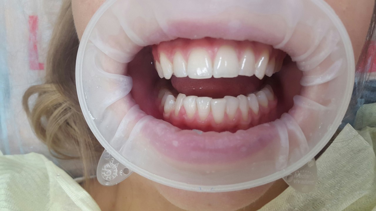 Отбеливание зубов системой Opalescense